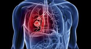 Use of AI to identify tuberculosis patients at Shuklaphanta