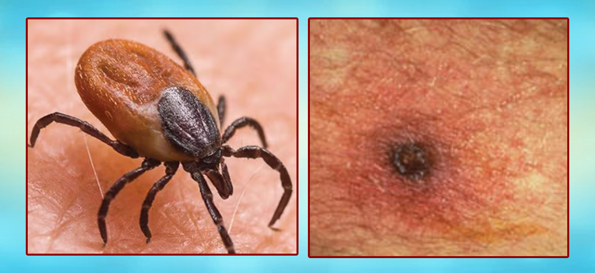 Bajura reports nine cases of scrub typhus in month