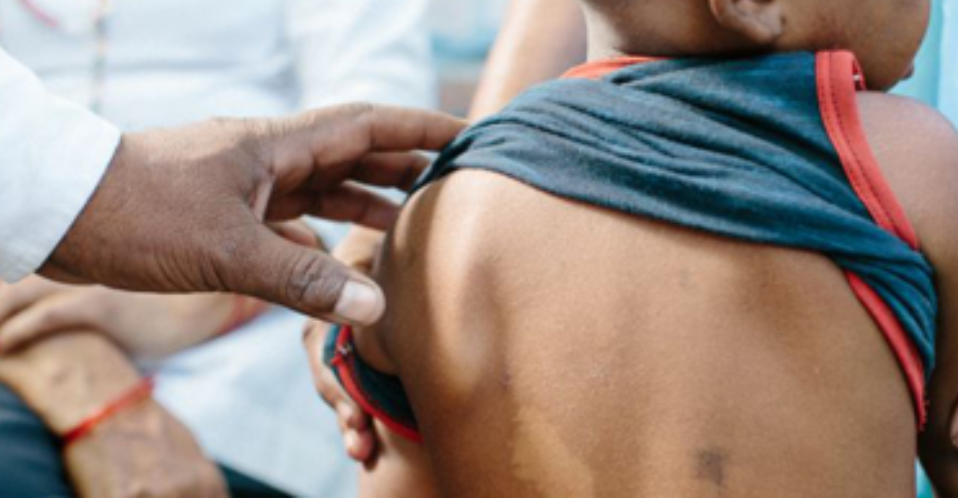 Banke, Bardiya face challenges for leprosy elimination